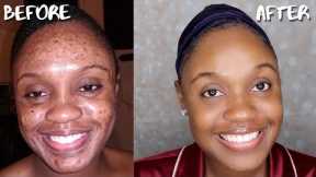AFFORDABLE SKIN CARE ROUTINE FOR ACNE, DARK MARKS, AND HYPERPIGMENTATION