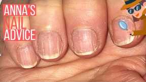 How To Care For Ridgy Nails  [ANNA'S NAIL ADVICE] 🕵️‍♀️
