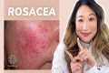 Dermatologist Guide to ROSACEA -
